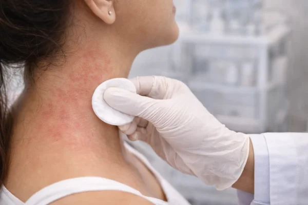 Skin Allergy Treatment